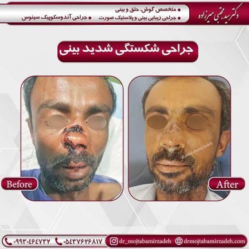 جراحی-شکستگی-شدید-بینی