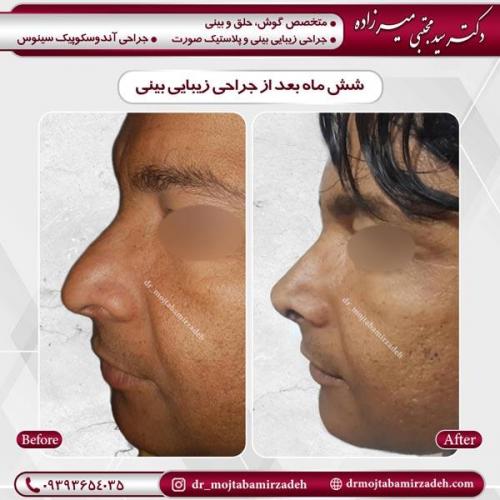 جراحی بینی 1