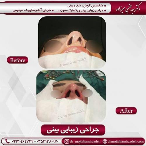 جراحی بینی 54 (13)