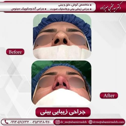 جراحی بینی 54 (16)