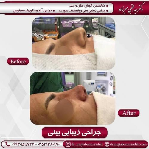 جراحی بینی 54 (17)