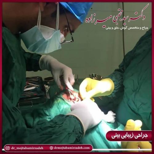جراحی بینی 54 (6)