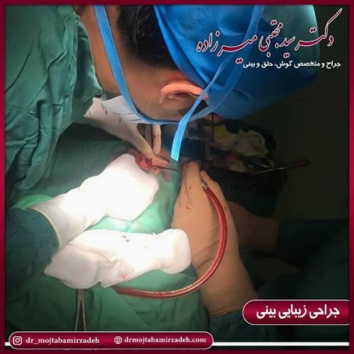 جراحی بینی 54 (7)