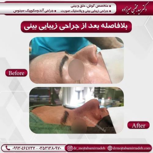 جراحی بینی 54 (8)