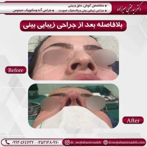 جراحی بینی 54 (9)