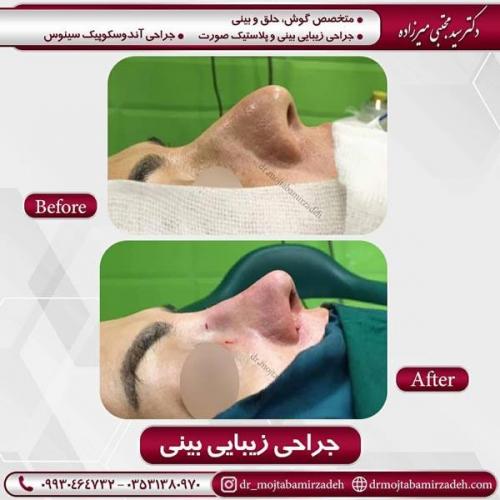 جراحی بینی در یزد 82