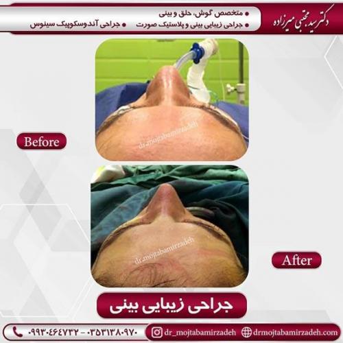 جراحی بینی در یزد 83