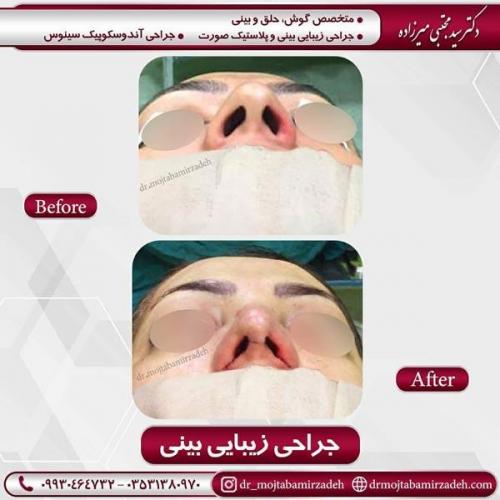 جراحی بینی در یزد 84