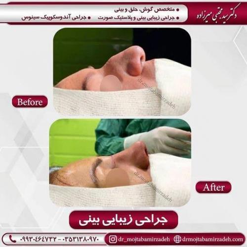 جراحی بینی در یزد 85