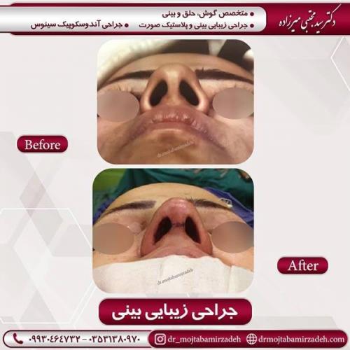 جراحی بینی در یزد 87