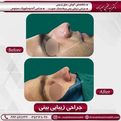 جراحی بینی در یزد 88