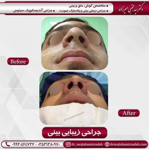 جراحی بینی در یزد 89