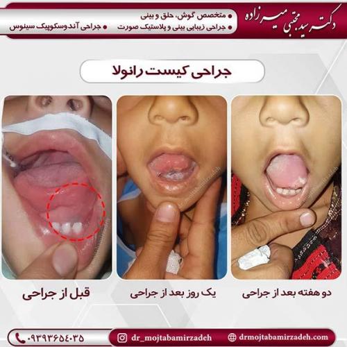 جراحی-کیست-1