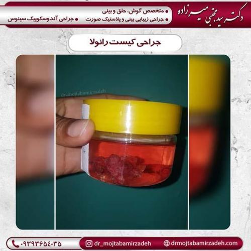 جراحی-کیست-2
